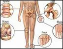 Arthritis