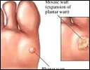 Wart